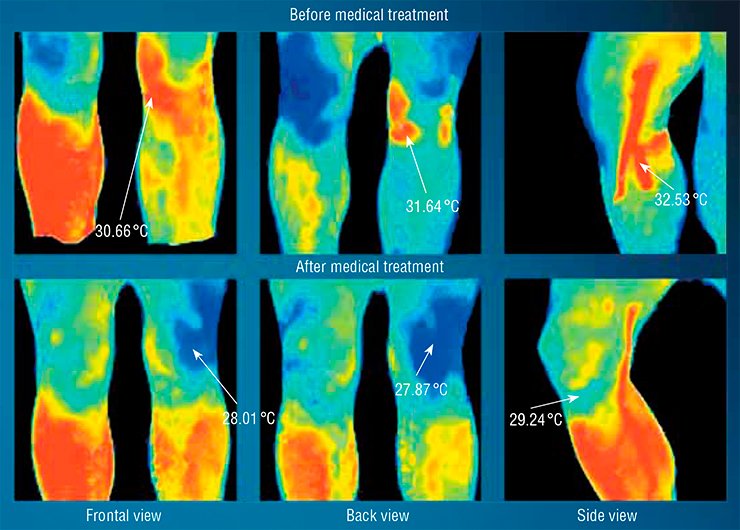 The thermogram helps the physician to control the process of healing of the injury of the left knee 