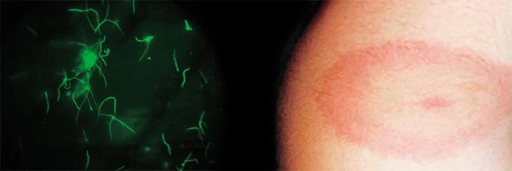 Боррелии, как все спирохеты, представляют собой длинные и тонкие, спирально закрученные клетки (слева). Фото Н. В. Фоменко. Выявить заражение боррелиями можно по появлению на коже красного кольца в месте укуса клеща, которое появляется в результате воспалительной реакции на проникших в организм бактерий (справа)