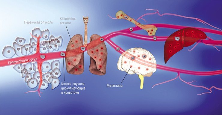 Некоторые клетки первичной опухоли выходят в кровоток или лимфоток и путешествуют по сосудистой системе. Задерживаясь в узких капиллярах органов и «прилипая» к их внутренней стенке, они из просвета сосуда переходят в строму органа. Лишь немногим раковым клеткам удается при этом выжить, но именно они формируют новые очаги роста опухоли – метастазы. По: (Massagu, Obenauf, 2016)