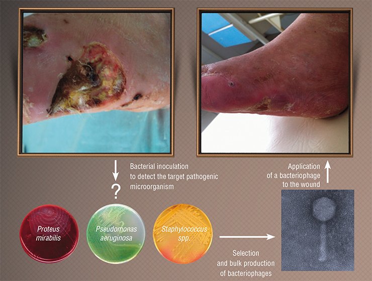 Diabetic foot, a severe complication of diabetes with potential development of gangrene, foot loss, and disablement, is experimentally treated in a Novosibirsk clinic. Bacterial infection is one of the factors underlying this pathology. Phage therapy comprises the following stages: swabbing the affected tissues to isolate the pathogenic bacterium; selecting the bacteriophage that can lyse the target bacterium from a phage collection; and applying the bacteriophage preparation (on a sterile pad) to the wound. The treatment takes about a week