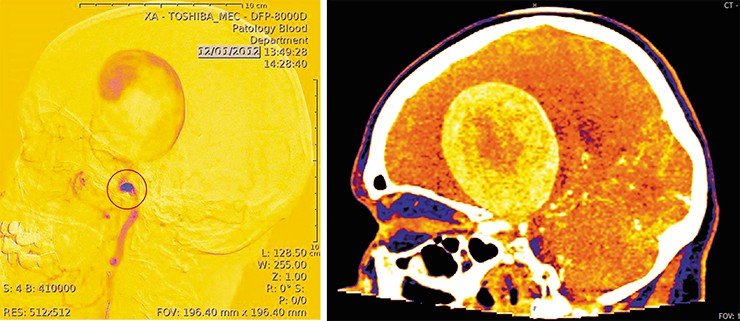 Слева: Артериальная аневризма (АА) – выпячивание стенки артерии вследствие ее растяжения. Материал стенки аневризмы отличается от материала стенки здорового сосуда. Ангиограмма выполнена в ННИИПК им.акад.Е.Н. Мешалкина. Справа: гигантская артериальная аневризма, компьютерная томография