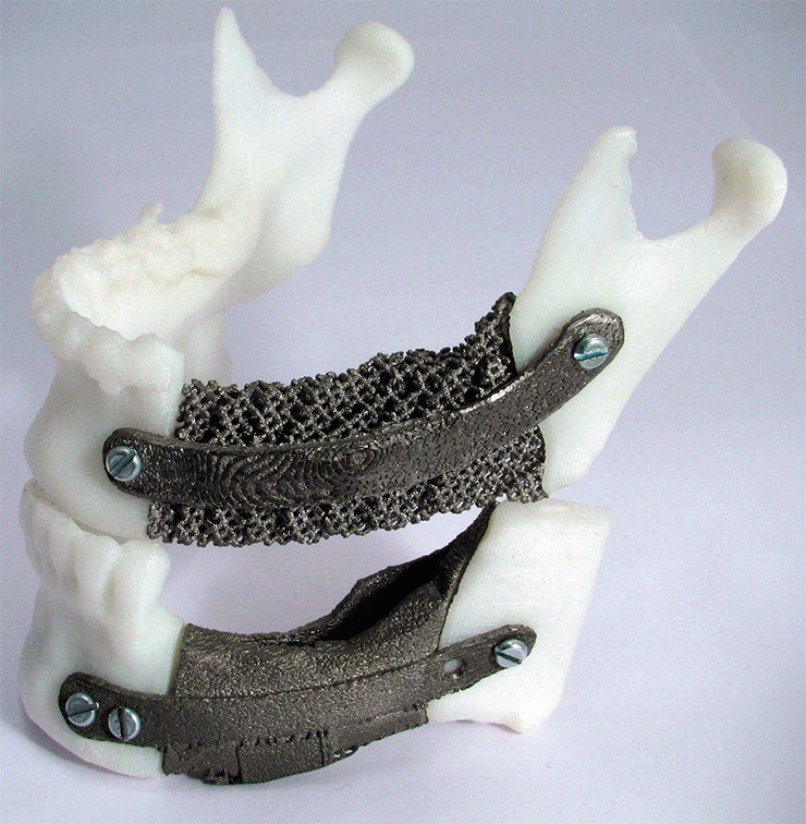 В этом сложном клиническом случае недостающие части челюсти пациента были замещены металлическими имплантатами с «гнездами» для будущих зубных протезов. При этом использовался как цельнометаллический протез (нижняя модель) так и протез из трехмерной металлической «сетки» (верхняя модель). Крепежные пластины и замещающие имплантаты, созданные по аддитивной технологии из медицинского титан-алюминий-ванадиевого сплава, представляют собой единое целое
