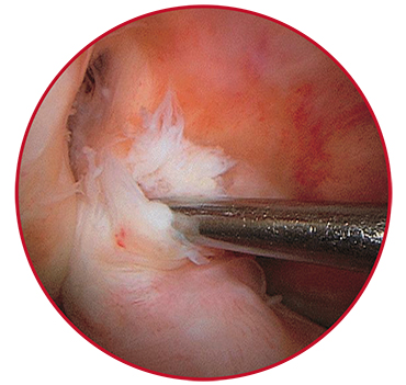 The knee joint cavity as seen during arthroscopic examination