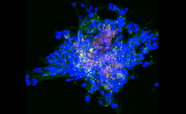 Инвазивная опухоль молочной железы, выращенная из раковых клеток в модельной системе, имитирующей ткань молочной железы человека. Синим цветом окрашены ядра клеток, зеленым и розовым – белки клеточного цитоскелета, влияющие на структуру и форму клетки. Клетки в середине опухоли содержат больше всего этих белков, что позволяет им метастазировать. Флуоресцентная микроскопия. ©CC BY 4.0/ Sshah74