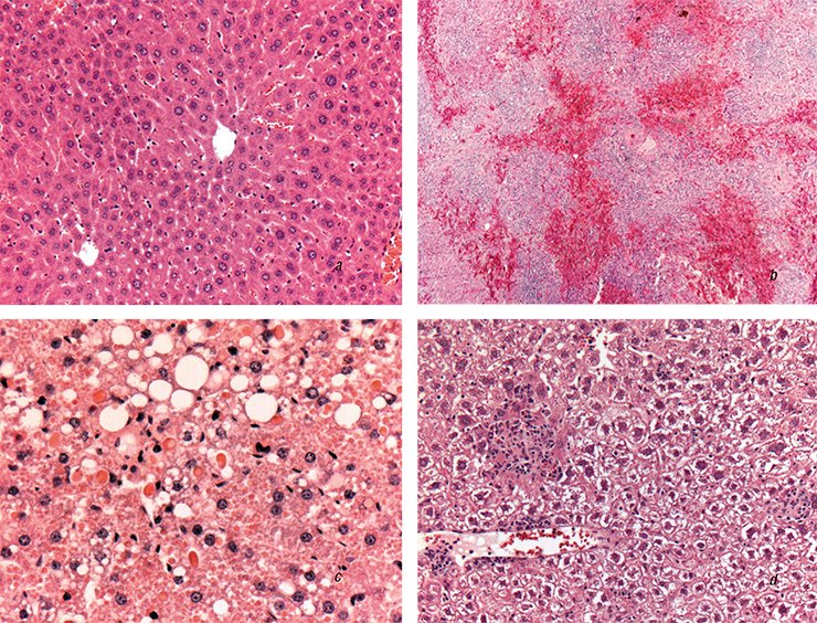Histological sections of the laboratory mouse liver demonstrate all stages of acute toxic liver injury with characteristic necrosis of hepatocytes, microdroplet fatty degeneration, and fibrogenesis: (a) the norm; (b) acute toxic hepatitis; (c) chronic steatohepatitis (yellow denotes droplets of fat (lipid) droplets); and (d) fibrosis (dark blobs)