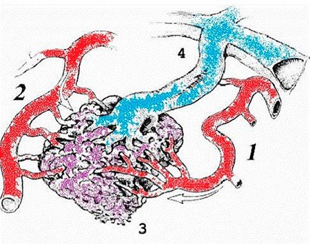 Артериовенозная мальформация (АВМ). 1,2 – питающие артерии,3 – ядро АВМ,4 – дренирующая вена