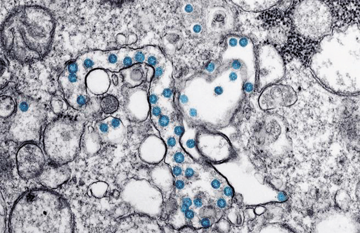 Изолят SARS-CoV-2 (вирусные частицы сферические, синего цвета) от первого заболевшего в США. Внутри частиц видны черные точки – поперечные сечения вирусного генома. Просвечивающая электронная микроскопия. © Centers for Disease Control