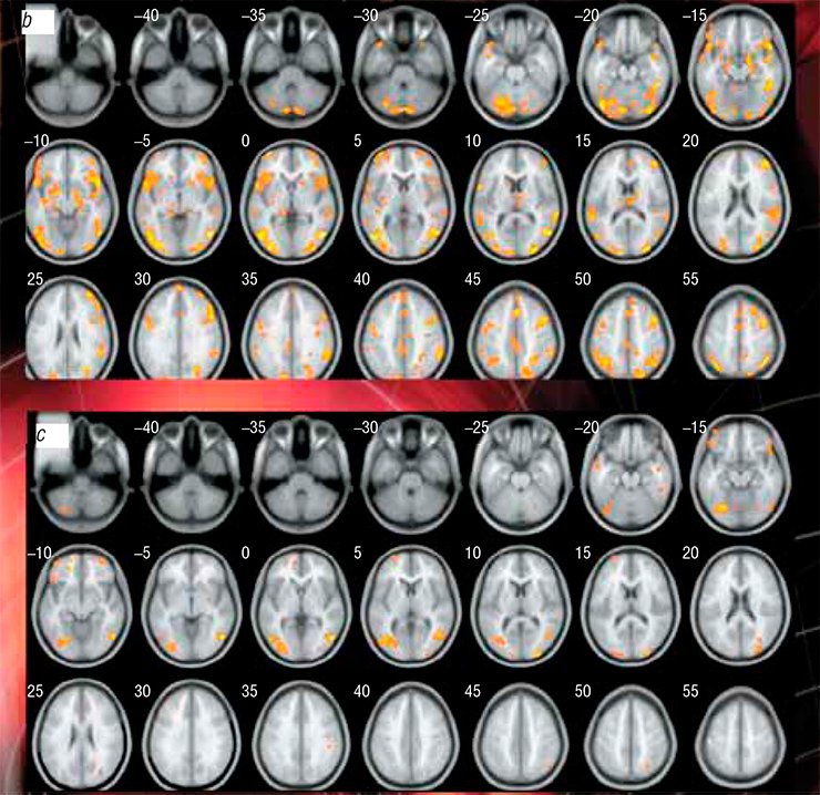 While the 16 players were playing Vira!, fMRI was used to study the emergence and development of their brain activity zones in. (b) At the “peak” of the competition (fourth—sixth attempts), an ever increasing number of newly formed neuronal ensembles are recruited into the struggle for the prize. New activity zones appear in the cortical, cerebellar, and stem structures as well as in the middle parietal and frontal gyri. (c) At the “finish”, the activation zones (of reduced sizes) are retained in the symmetrical posterior lobes of the cerebellum, pyramids, declive, middle frontal gyri, and occipital gyri