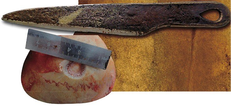 Экспериментальная трепанация на черепе трупа была выполнена практикующим нейрохирургом современным бронзовым ножом, изготовленным по древним образцам (вверху)