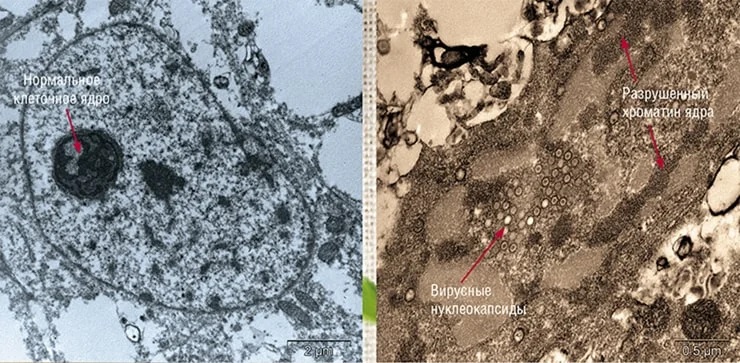 Клетки культуры Vero, предварительно обработанные водным экстрактом чаги (стерильных плодовых тел трутовика скошенного, Inonotus obliquus) не подверглись заражению (слева). В необработанных клетках были обнаружены многочисленные вирусные нуклеокапсиды и нарушения структуры клеточного ядра («спекание» хроматина) (справа) (Теплякова, Казачинская и др., 2012). Фото Е. Рябчиковой 