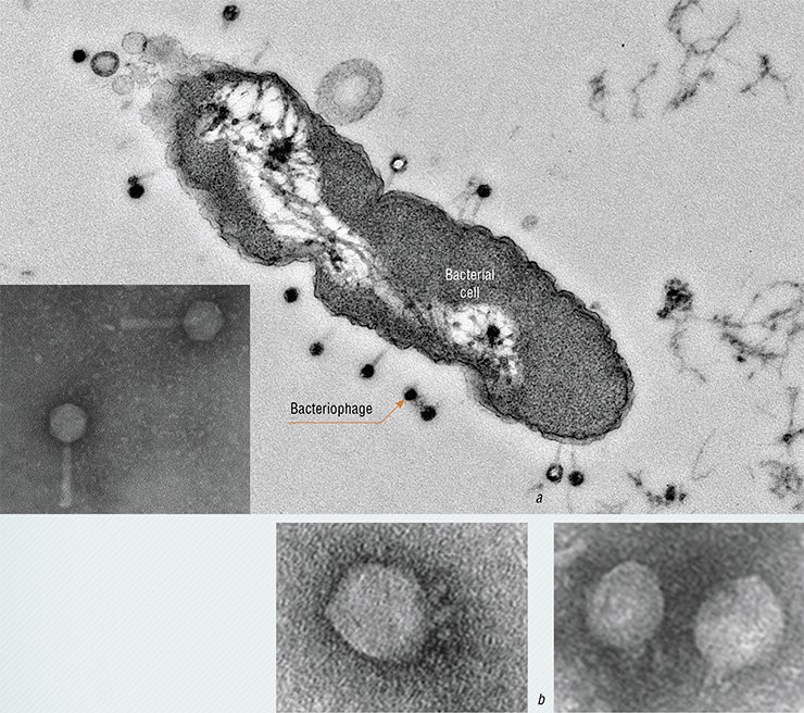 (a) “Tailed” bacteriophages attacking the bacterium Pseudomonas aeruginosa (blue pus bacillus) and (b) the bacteriophages that infect the bacterium Proteus mirabilis, causing urogenital infections, in particular, prostatitis, cystitis, and pyelonephritis. Electron microscopy. By the courtesy of E. I. Ryabchikova