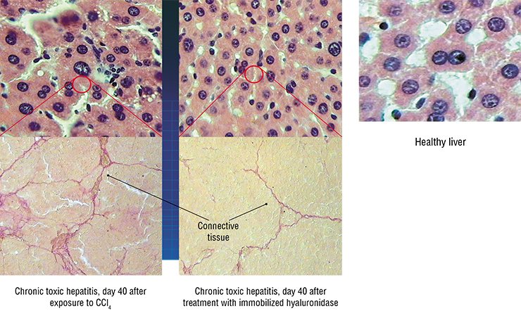 Efficiency of the therapeutics immobilized on polyethylene glycol was tested in the animal model of chronic hepatitis induced by exposure to carbon tetrachloride (CCl4). The hyaluronidase immobilized on polyethylene glycol (imHD) not only prevented liver sclerotization (growth of cicatricial connective tissue) in sick animals, but also considerably decreased inflammation (above) and the hepatocyte secretion of toxic bile acids. The granulocyte colony-stimulating factor immobilized on polyethylene glycol (imG-CSF) had a similar effect on liver sclerotization
