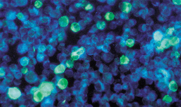 Среди этих клеток от пациента с лейкозом есть и зараженные вирусом Эпштейна – Барра – одним из герпесвирусов, способных вызывать респираторные заболевания. Благодаря использованию флуоресцентных антител такие клетки светятся зеленым в ультрафиолетовом свете. © CDC/ Dr. Paul M. Feorino