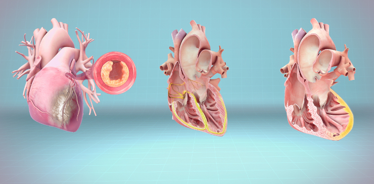 Изображения сердца при сердечно-сосудистых болезнях: инфаркте миокарда, остановке сердца и сердечной недостаточности. ©CC BY-SA 4.0/www.scientificanimations.com/wiki-images/ 