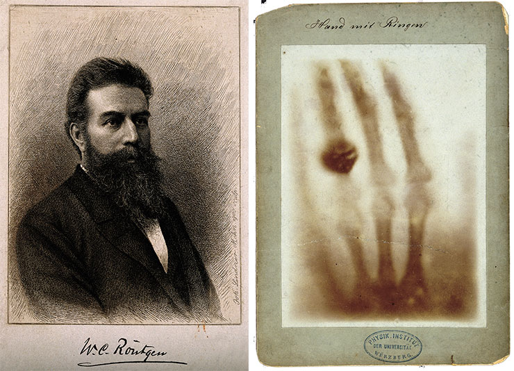 The discoverer of radioactivity Wilhelm von Röntgen (above) and a photo print of his 1985 radiograph, which shows finger bones with a ring on one of the fingers (right). Collection gallery. © CC BY 4.0