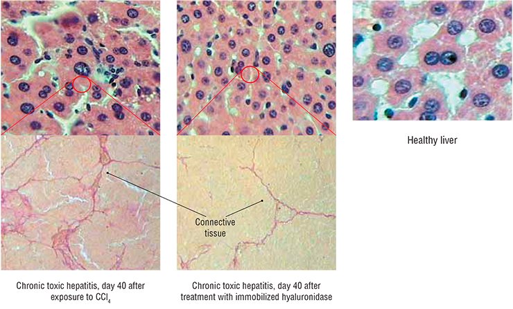 Efficiency of the therapeutics immobilized on polyethylene glycol was tested in the animal model of chronic hepatitis induced by exposure to carbon tetrachloride (CCl4). The hyaluronidase immobilized on polyethylene glycol (imHD) not only prevented liver sclerotization (growth of cicatricial connective tissue) in sick animals, but also considerably decreased inflammation (above) and the hepatocyte secretion of toxic bile acids. The granulocyte colony-stimulating factor immobilized on polyethylene glycol (imG-CSF) had a similar effect on liver sclerotization