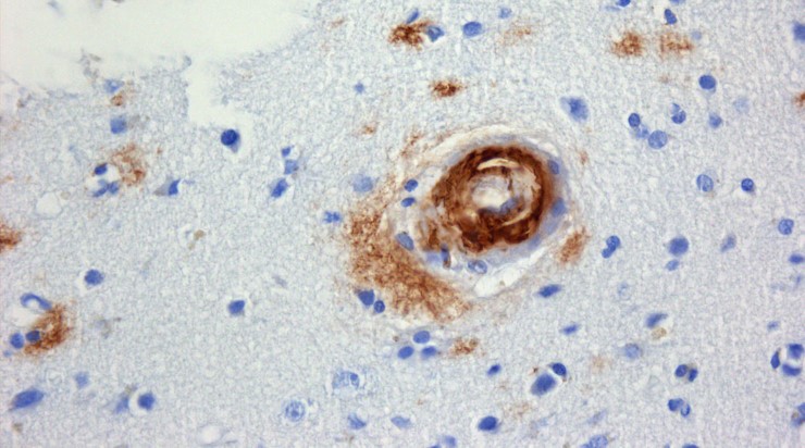 Отложения патологического белка бета-амилоида (коричневого цвета) при церебральной амилоидной ангиопатии. © CC BY-SA 3.0/ Jensflorian