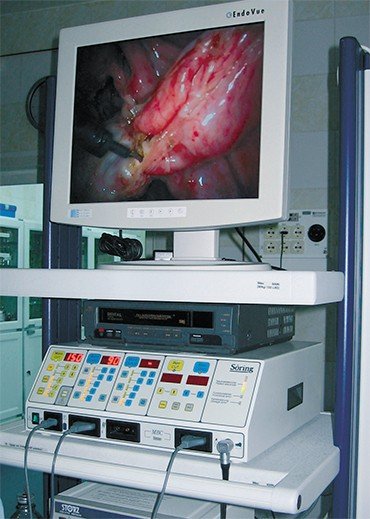 Каждый этап операции отображается на мониторе эндоскопической стойки