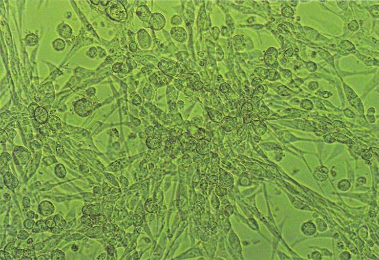 Клетки рабдомиосаркомы – опухоли поперечно-полосатых мышц человека, зараженные лизирующим аденовирусом 6-го типа. Световая микроскопия