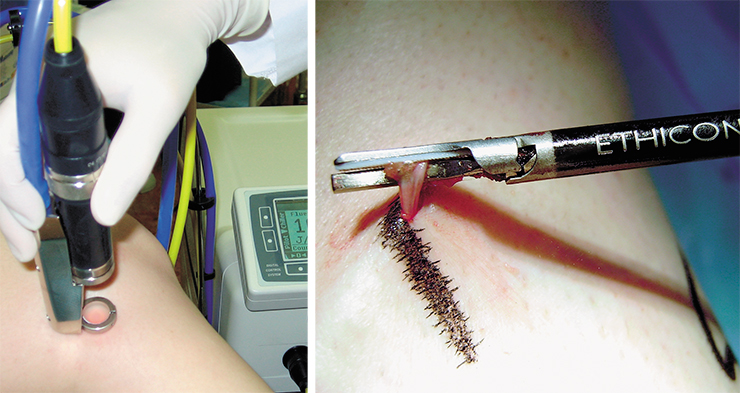 Today varicose veins are treated by various methods. Minimally invasive surgical removal of veins with the help of an ultrasonic scalpel is performed through small incisions in the skin (right). The lumens of small veins can be healed nonsurgically, by laser radiation acting through the skin. At the Novosibirsk Center for New Medical Technologies, they use a special device designed at the Institute of Laser Physics, Siberian Branch of the Russian Academy of Sciences (left)