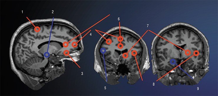 К сегодняшнему дню уже выделены наиболее перспективные области головного мозга для биоуправления по фМРТ в целях терапии тех или иных заболеваний и патологий. Моторные области (премоторная, сенсомоторная) мозга (1) целесообразно задействовать в случае постинсультной реабилитации; черную субстанцию (2) – при болезни Паркинсона; орбитофронтальную кору (3) – при фобиях; префронтальную кору (медиальную часть)  (4) – при злоупотреблении алкоголем и никотином и при депрессиях и фобиях (латеральную часть); нижнюю лобную извилину (5) – при компульсивном переедании; переднюю поясную извилину (6) – при хроническом болевом синдроме, шизофрении и депрессии; вентральную часть стриатума (7) – при злоупотреблении алкоголем; переднюю кору островка (8) – при хроническом болевом синдроме, шизофрении, депрессиях и т. д.; левую миндалину (9) – при депрессии. Красным цветом отмечены зоны, исследованные на больных, синим – гипотетически важные или протестированные только на здоровых людях
