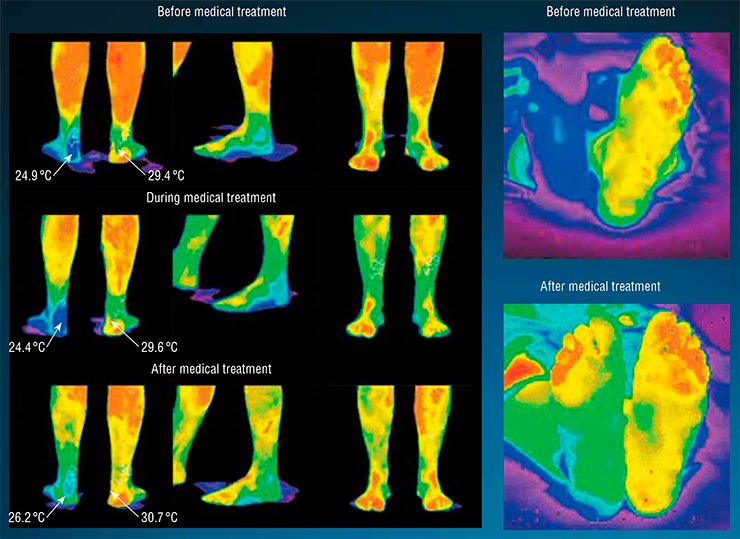 Diabetic foot: the affected foot has a lower temperature than the healthy foot. The increase in temperature after medical treatment testifies to the  recovery of blood circulation in damaged areas and to medical treatment effectiveness. Diabetic foot (the right foot is injured). The increase in temperature, which testifies to the recovery of blood circulation, is clearly visible (right) 