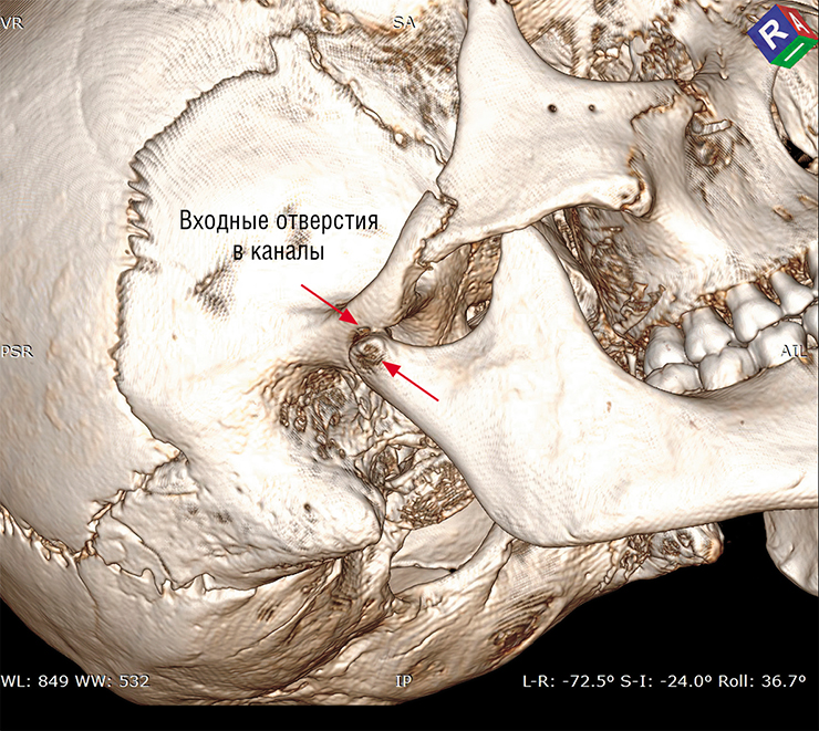 На восстановленной 3D-модели черепа видны входные отверстия в каналы, просверленные в черепе из кургана № 2 могильника Верх-Кальджин-2