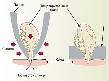 При удалении присосавшихся клещей пинцетом их ни в коем случае нельзя сжимать с боков (слева), чтобы не вызвать противотока слюны из клеща под кожу хозяина, так как это несет опасность дополнительного инфицирования патогенами