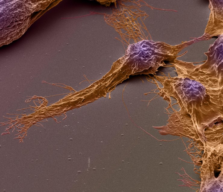 Раковые стволовые клетки человека, выделенные у пациента с раком головного мозга. Ядро окрашено фиолетовым. Сканирующая электронная микрофотография. © CC BY 4.0/ Izzat Suffian, Pedro Costa, Stephen Pollard, David McCarthy & Khuloud T. Al-Jamal  