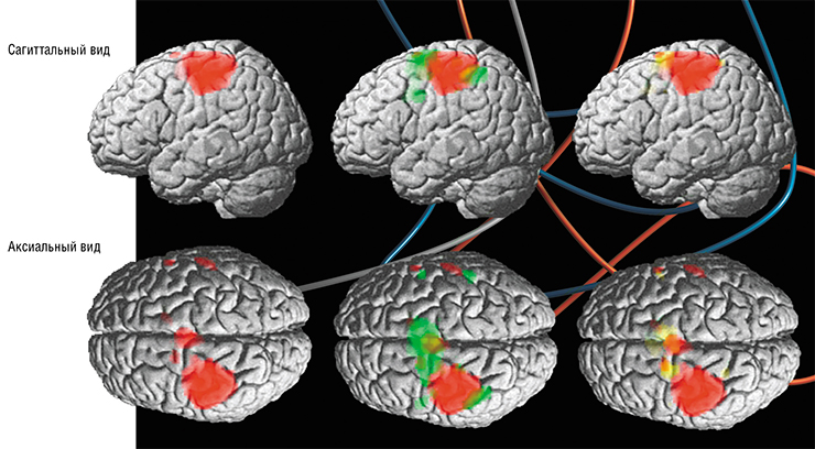 При реальном сжимании кисти в кулак происходит активация корковых моторных областей; аналогичный процесс идет и при попытке воспроизвести подобный ответ мозга усилием воли. В случае правой руки активируются участки в левой первичной моторной коре – целевом регионе (показаны красным цветом). Зеленым цветом отмечены области, активированные при нейробиоуправлении (приемы волевого управления по усмотрению пациента); желтым – области, активированные при попытках саморегуляции с помощью воображения действия. Видно, что в этом случае начинают работать соседние зоны мозга с небольшим перекрытием целевого региона. По: (Мельников и др., 2017)
