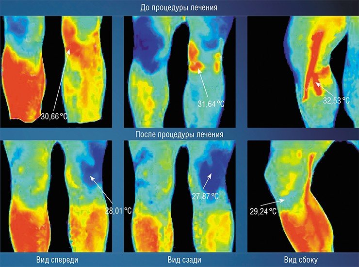 Термограмма помогает врачу контролировать процесс лечения травмы левого колена