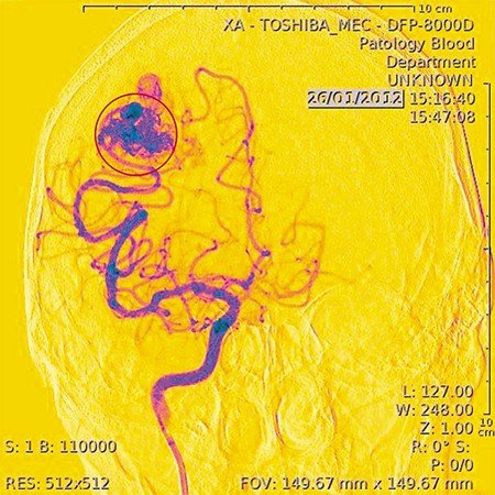 Артериовенозная мальформация (АВМ) – патологическая связь между артериями и венами, вследствие которой осуществляется прямое шунтирование (сброс) крови из артериального бассейна в венозный. На снимке не выключенная из кровотока АВМ. Ангиограмма выполнена в ННИИПК им.акад.Е.Н. Мешалкина