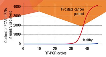 The prostate-specific antigen (PSA) is routinely used as a marker for diagnosing prostate cancer. However, the PCA3 gene is considerably more specific marker for prostate cancer, since this gene is not activated in benign prostatic hyperplasia and inflammation. Thus, in the case of an ambiguous diagnosis (currently, this is seven cases of ten), a good criterion for justified biopsy is the presence of either PCA3 protein or the messenger RNA of PCA3 gene (carrying the information about amino acid sequence of this protein) in urine (above). The study was performed by N.A. Os’kina and U.A. Boyarskikh (Group of Pharmacogenetics, Institute of Chemical Biology and Fundamental Medicine, Siberian Branch, Russian Academy of Sciences, Novosibirsk, Russia)