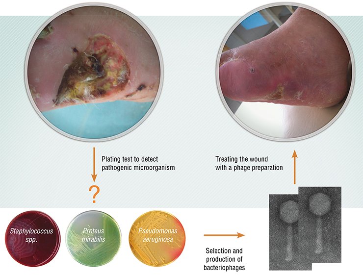 A Novosibirsk clinic is involved in experimental treatment of the diabetic foot, a severe complication of diabetes mellitus that may lead to gangrene, foot loss, and disability. Infection is one of the factors that cause this pathology.Phage therapy for the diabetic foot comprises (i) swabbing the wound in order to identify the involved pathogenic bacteria; (ii) screening the phage collection to find the phage capable of lysing the identified bacteria; and (iii) applying a sterile phage preparation to the wound. The treatment course takes about a week