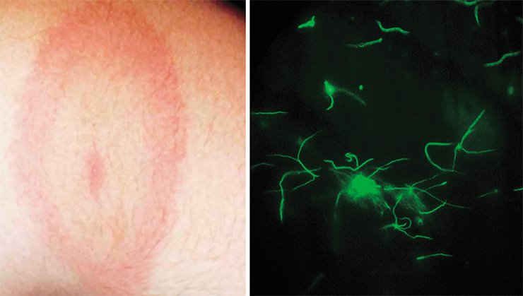 The first external sign of borreliosis is a red circle appearing around the site of a tick bite, which is a manifestation of the inflammatory response to the bacteria that have entered the body. The bacterium itself like its closest relative treponema, the agent of syphilis, resembles a coiled helix. Photo by the courtesy of N. Fomenko (Institute of Chemical Biology and Fundamental Medicine, SB RAS, Novosibirsk)