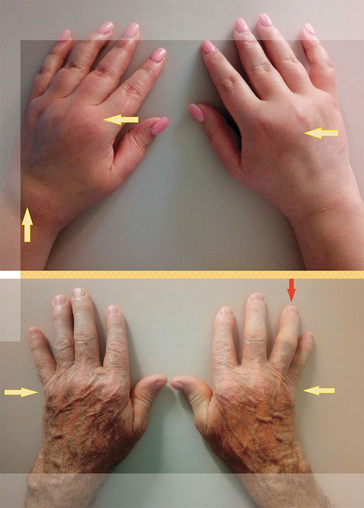 При ревматоидном артрите в первую очередь обычно воспаляются мелкие суставы обеих рук с одновременным поражением лучезапястных суставов (вверху). Постепенно болезнь приводит к деформации пальцев, в результате чего они фиксируются в полусогнутом положении, утрачивая способность к разгибанию, – формируется контрактура (внизу). Красная стрелка – контрактура, желтые стрелки – «ластообразная» деформация кистей