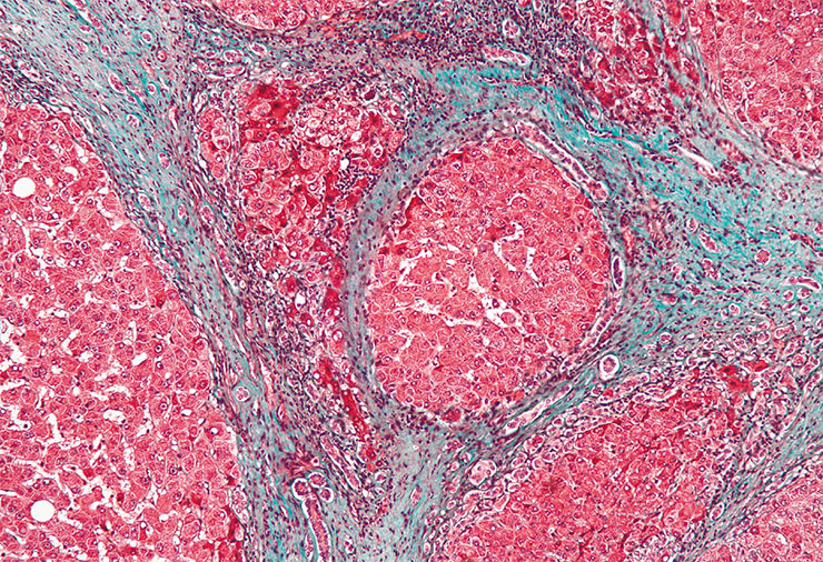 На микрофотографии образца печени больного циррозом видна узловатая структура из островков печеночной ткани, окруженных соединительной тканью (показана синим цветом). Окраска трихромом. © CC BY-SA 3.0/Nephron