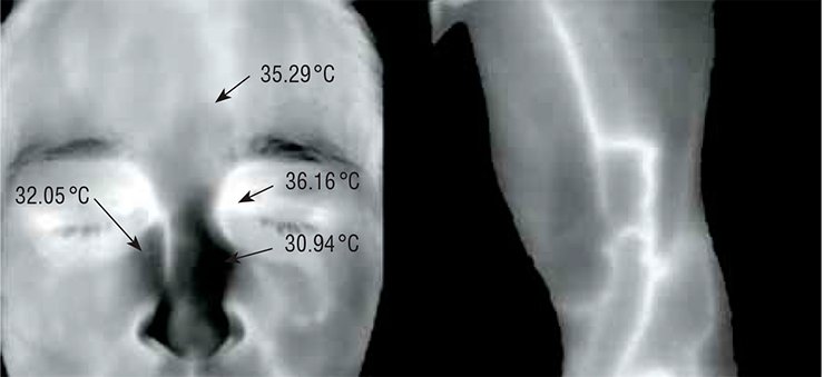 The thermogram can be used for diagnostic purposes: the inflammatory process in the Highmore antrum is evidenced by the temperature asymmetry in the nose region (left); the varicose disease is evidenced by the varicose veins of the lower limb, which are “marked” by high temperature (right)