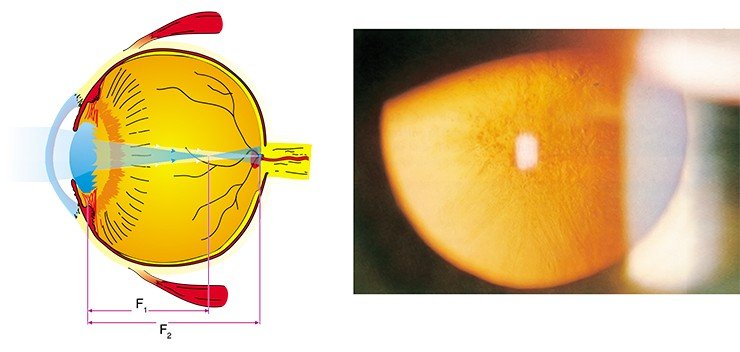 Слева: глаз человека с имплантированным искусственным хрусталиком. F1 и F2 – фокусы для ближнего и дальнего зрения. Справа: глаз человека, пораженный катарактой