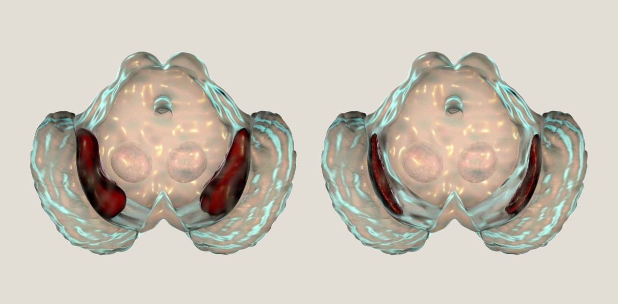 Слева – срез мозга здорового человека, справа – при болезни Паркинсона. Видно уменьшение объема черной субстанции (темные участки). © CC BY-NC 4.0 Слева – срез мозга здорового человека, справа – при болезни Паркинсона. Видно уменьшение объема черной субстанции (темные участки). © CC BY-NC 4.0