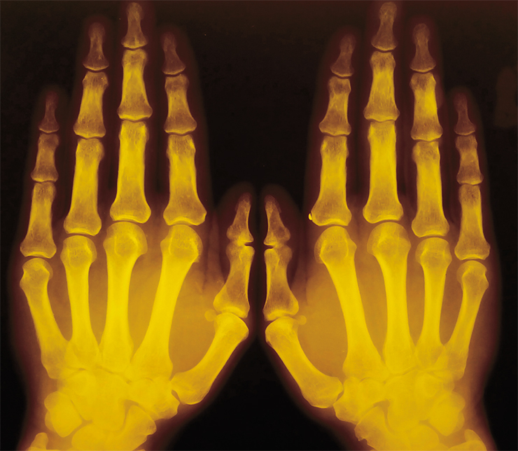 Кости и хрящи относятся к опорной соединительной ткани. Такая ткань в основном состоит из коллагеновых волокон, которые придают ей жесткость, а прочность костной ткани придают отложения солей кальция. На фото: рентгенограмма кисти, на которой видны пораженные остеопорозом участки костей (более темные места) около воспаленных суставов