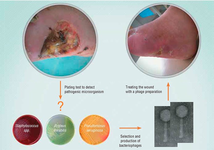 A Novosibirsk clinic is involved in experimental treatment of the diabetic foot, a severe complication of diabetes mellitus that may lead to gangrene, foot loss, and disability. Infection is one of the factors that cause this pathology.Phage therapy for the diabetic foot comprises (i) swabbing the wound in order to identify the involved pathogenic bacteria; (ii) screening the phage collection to find the phage capable of lysing the identified bacteria; and (iii) applying a sterile phage preparation to the wound. The treatment course takes about a week