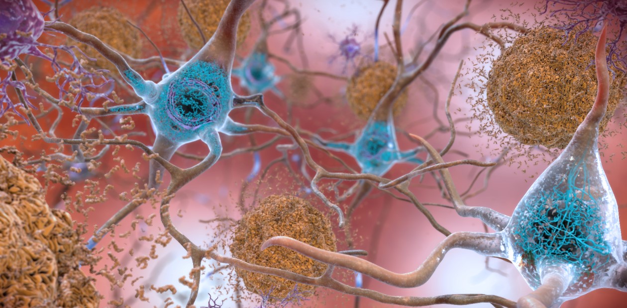 Бета-амилоидные бляшки (коричневым цветом) и аномальные скопления тау-белка (синим) в головном мозге при болезни Альцгеймера. © NIH Image GalleryFollow