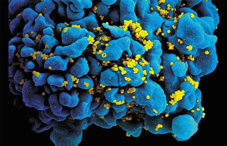 ВИЧ-инфицированная Т-клетка. Сканирующая электронная микрофотография. Credit: NIAID