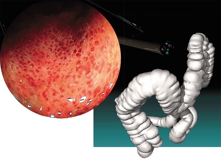 Эрозивные поражения слизистой толстой кишки: тяжелая форма язвенного колита – хронического воспалительного заболевания слизистой оболочки кишечника. Фото В. Г. Куликова (ЦНМТ, Новосибирск). 3D-модель толстой кишки создана по данным КТ-колонографии (справа). © CC BY-SA 3.0/ Nevit Dilmen