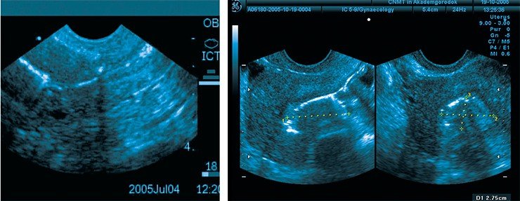 С помощью метода «4D контрастной гистеросонографии» можно визуализировать признаки эндометриоза тела матки. Полученная картина чем-то напоминает заснеженное дерево