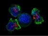 «Обученные» иммунные клетки-киллеры спасли больную раком груди в терминальной стадии