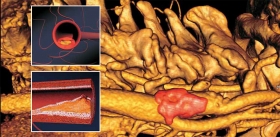 Atherosclerosis: A Tender Killer. From Theory to Practice