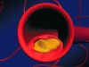 «Мусорщики»-макрофаги, пожирая погибшие клетки,  производят потенциальное лекарство от атеросклероза