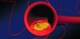 «Мусорщики»-макрофаги, пожирая погибшие клетки,  производят потенциальное лекарство от атеросклероза